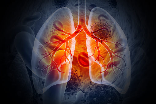 Lung-cancer-gathercare